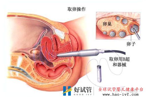女人做试管过程痛苦吗(图3) 女人做试管过程痛苦吗(图3)